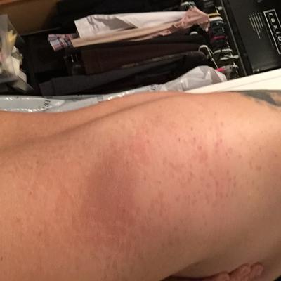 unknown spreading circular rash on leg