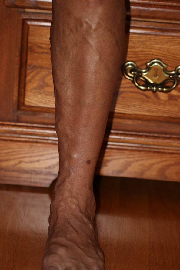 varicose veins on leg