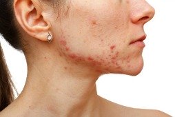 bad acne on a woman's face and chin