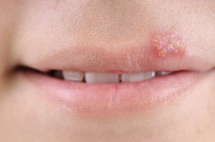 cold sore or fever blister on mouth area or lip