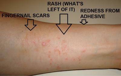 poison ivy looking rash on underside of forearm