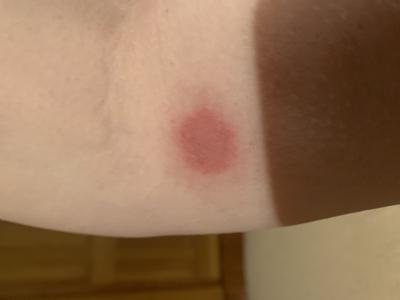 A round red rash that feels like a skin burn and hurts similar to a skin bruise.