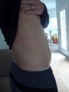 Intense skin rash on side of torso that cannot be treated successfully