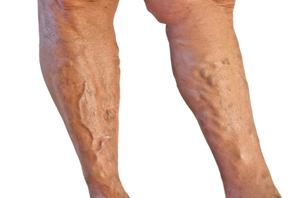 varicose veins skin problem on both legs